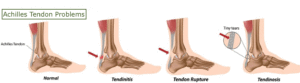 Achilles-Tendon-Problems