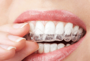 Nightguard-for-TMJ-Pain
