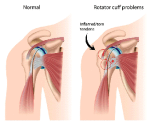 Rotator-cuff-tendon-problems