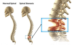 Spinal-stenosis