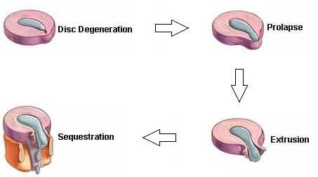 Stages-of-Disc-Herniation