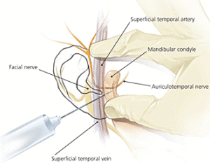 TMJ-injection-diagram