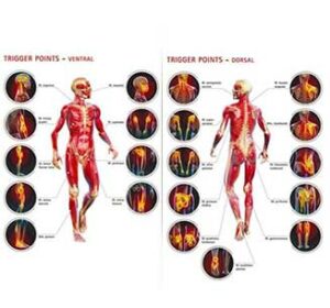 Trigger-points