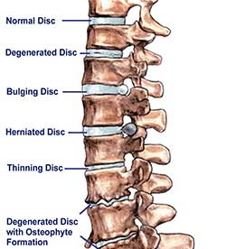 back-disc-problems