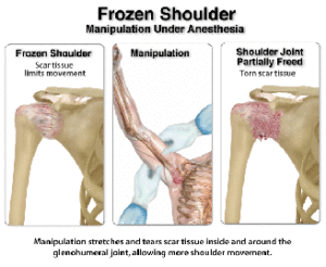 frozen-shoulder-manipulation