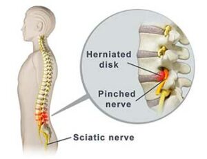 pinched_nerve_lower_back