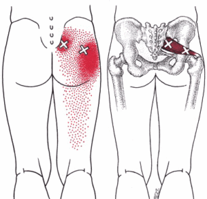 piriformis-trigger-point-injections