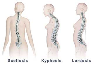 spinal_deformities