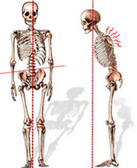 Poor-posture