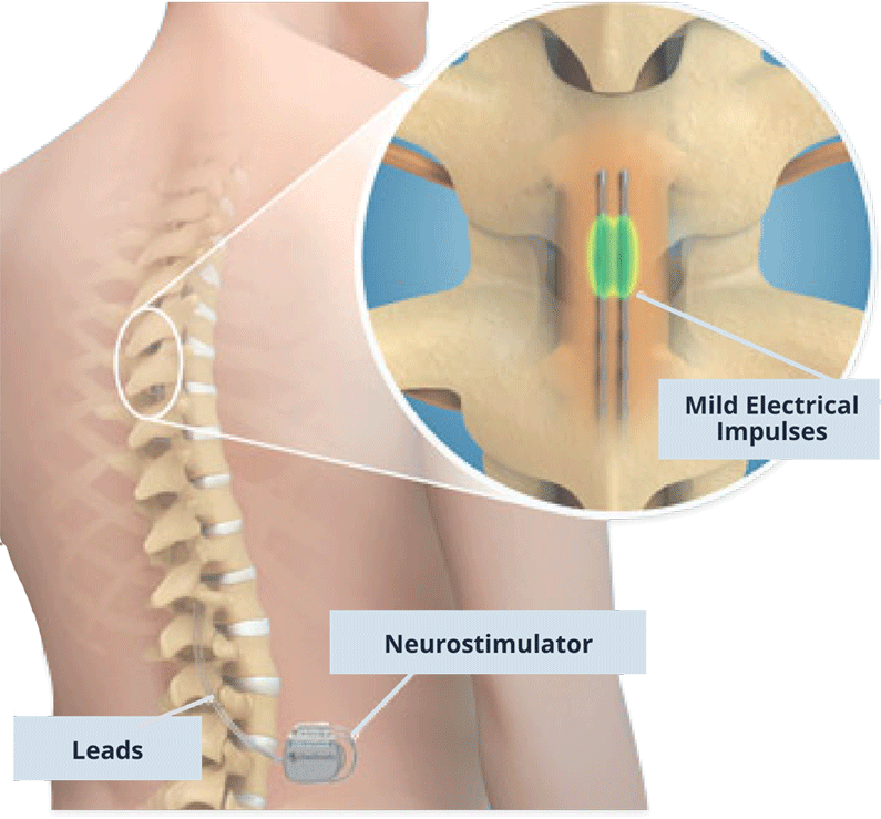 Neurostimulator-back-pain
